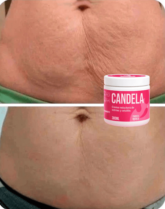 Candela - con su uso constante mejora la apariencia de la piel con estrías y celulitis
